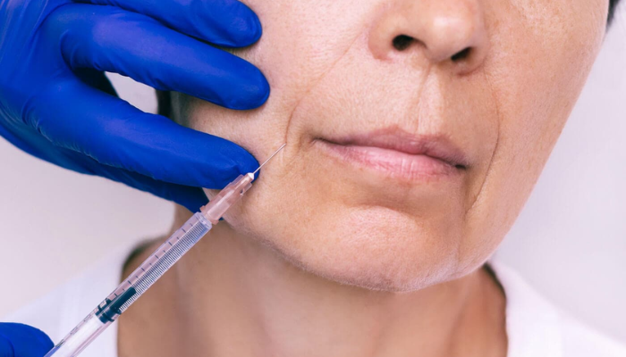 Filler for Smile Lines: Types, Results, Risks, and What to Expect filler for smile lines
